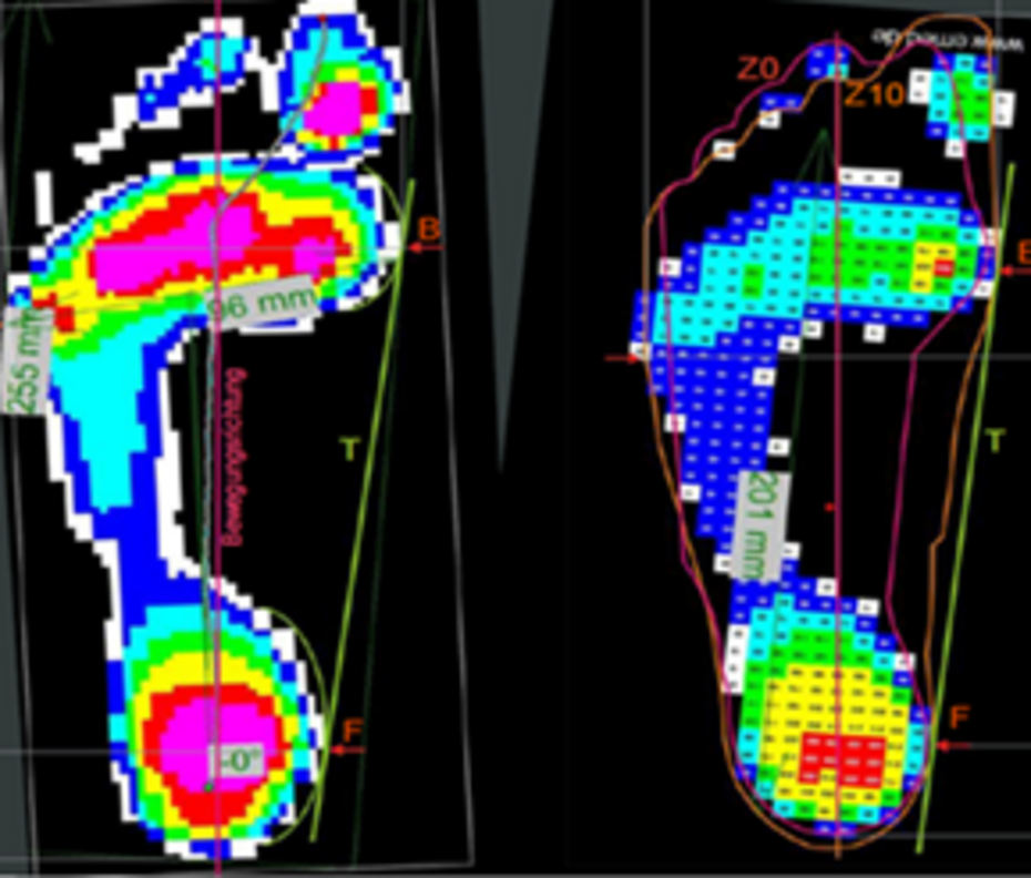 Measurement of plantar pressure distribution (ISC) Measurement of plantar pressure distribution (ISC)