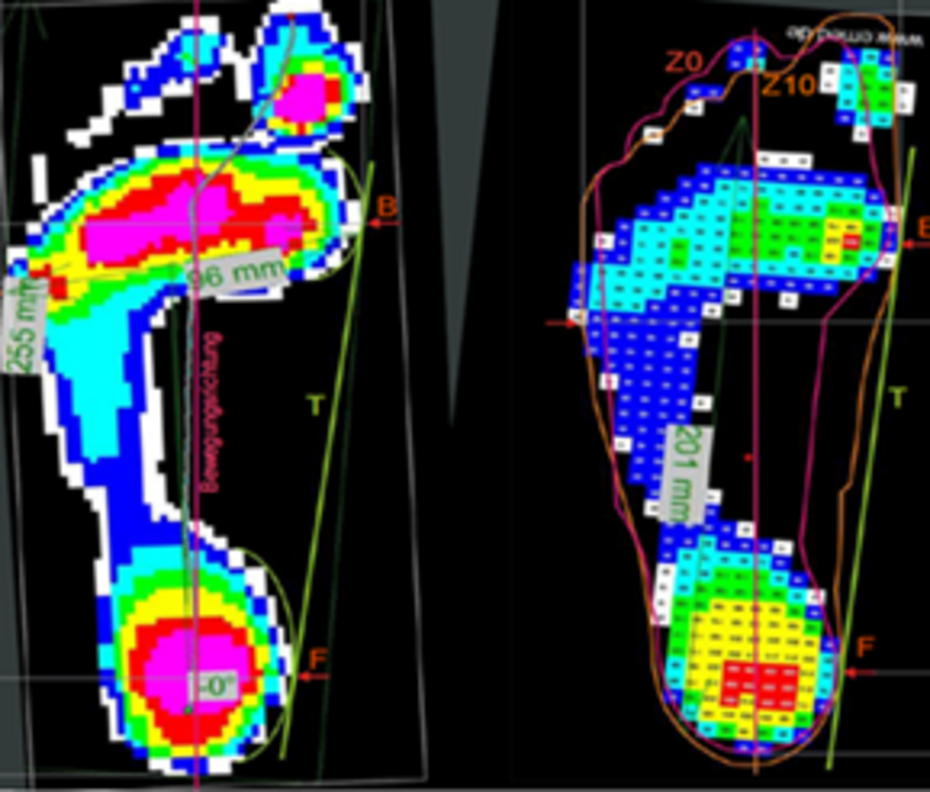 Measurement of plantar pressure distribution (ISC)